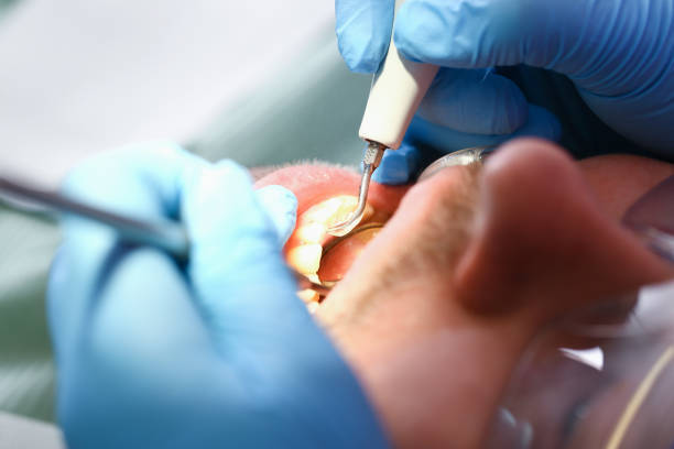 Best Emergency Dentist for Lost Fillings or Crowns in Springville, NY